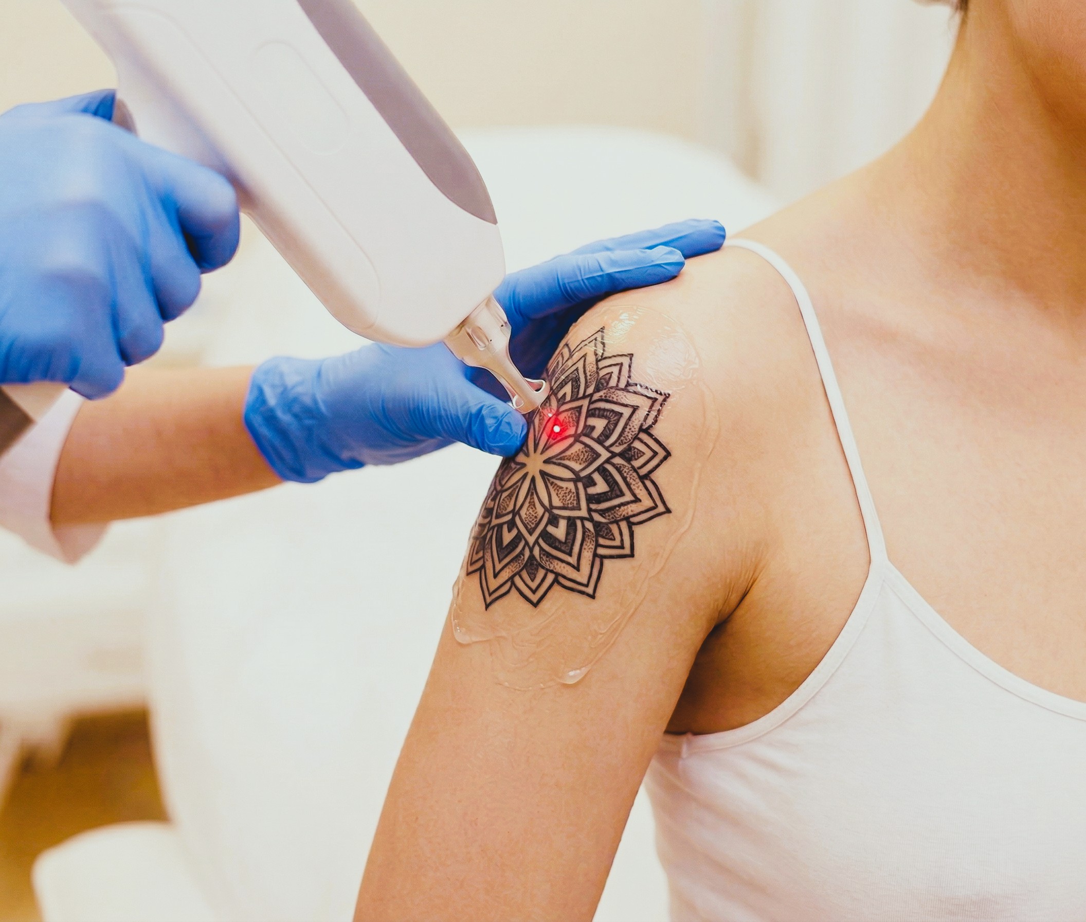 Tetoválás eltávolítás